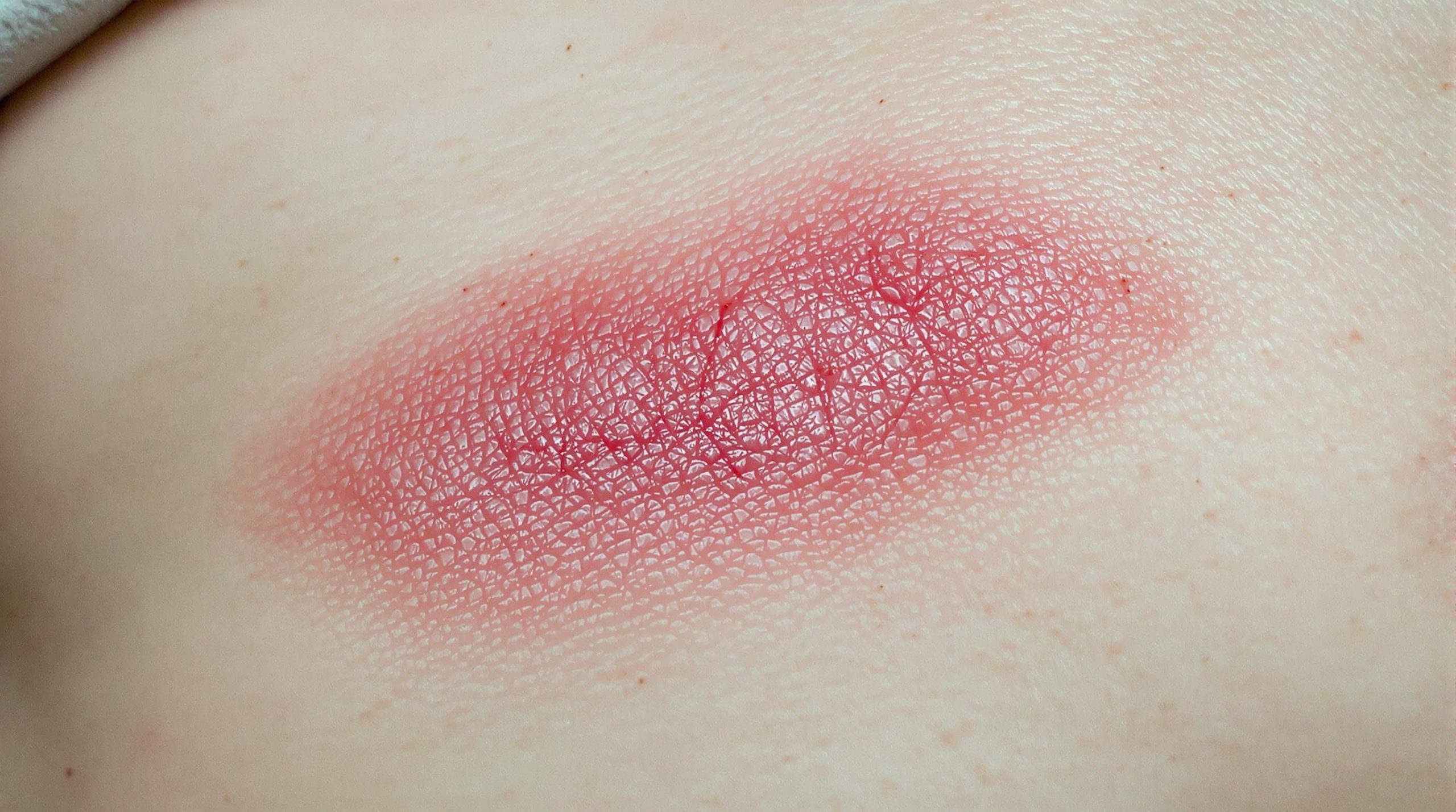 Vieille cicatrice qui gonfle : causes et solutions